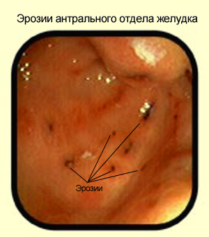 диета при острый гастрит