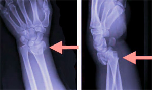 Переломы костей предплечья (локтевой и лучевой кости)