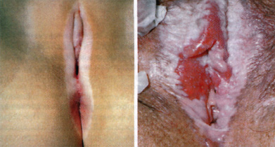 склероатрофический лихен половых губ у женщин в виде болячек