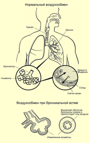 Лечение бронхиальной астмы, фото