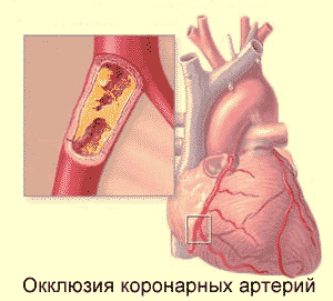 Атеросклероз коронарных артерий, фото