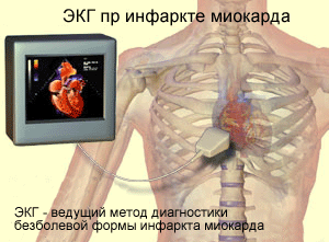 Атипичное течение инфаркта миокарда, фото