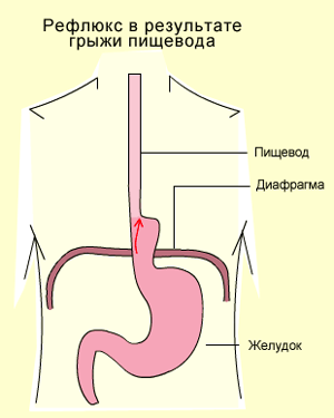 Дистальный отдел пищевода. Рефлюкс-эзофагит дисфагия. Гастроэзофагеальная рефлюксная болезнь. Рефлекс пищеводного желоба.