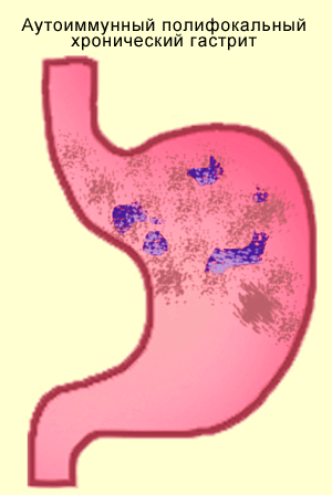 Что такое аутоиммунный гастрит. Аутоиммунный гастрит (гастрит типа а). Аутоиммунный фундальный гастрит. Аутоиммунный фундальный атрофический гастрит. Хронический атрофический гастрит типа а.
