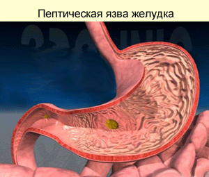 Пептическая язва желудка, фото