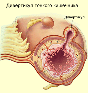 Дивертикул кишечника, фото