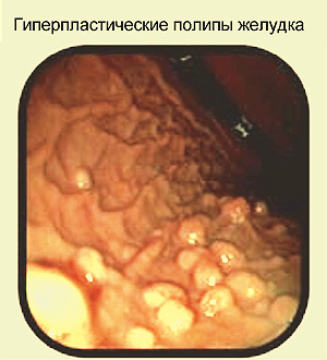 Гиперпластический полип желудка, фото