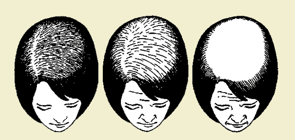 Алопеция или выпадение волос у женщин