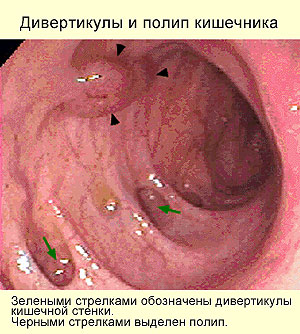 Дивертикулез кишечника, фото