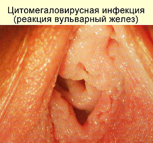 Клиническая картина цитомегаловирусной инфекции, фото