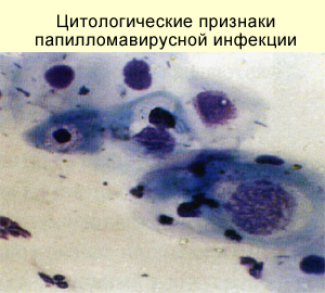Диагностика папилломавирусной инфекции, фото