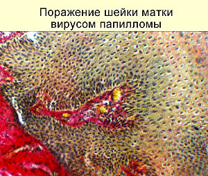 Вирус папилломы на шейке матки, фото