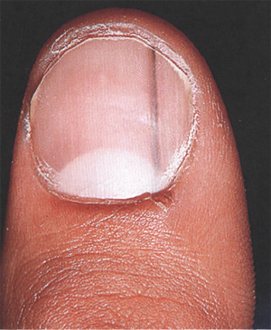 Коричневые полоски на ногте, фото