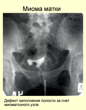 Миома на задней стенке матки