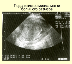 Диагностика миомы матки при УЗИ, фото