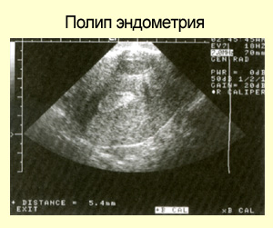 Забеременеть с полипом в матке. Полип эндометрия полости матки УЗИ. УЗИ картина полипа эндометрия. Полип эндометрияна УЗМ.