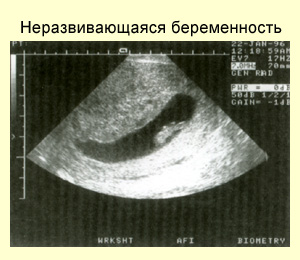Диагностика неразвивающейся беременности, фото