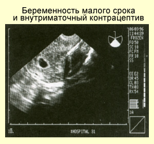 Диагностика осложнений внутриматочной контрацепции, фото