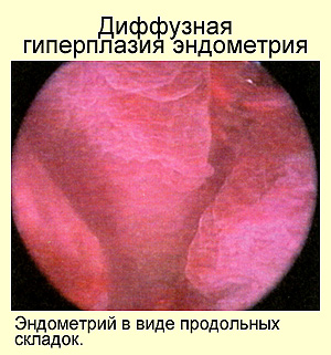 Гиперплазия эндометрия, фото