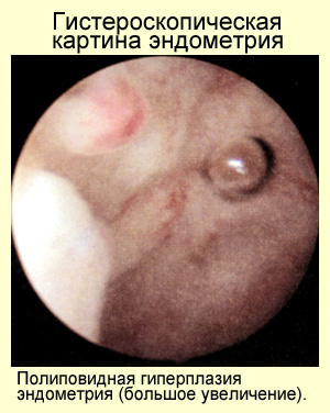 Полиповидная форма гиперплазии эндометрия, фото