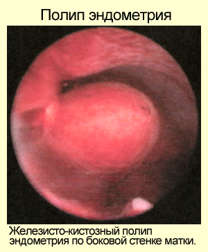 Как выглядят железисто-кистозные полипы эндометрия, фото