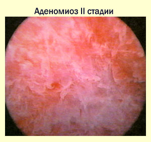 II стадия аденомиоза, фото