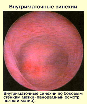 Причины развития внутриматочных синехий, фото