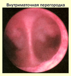 Диагностика перегородки в матке, фото