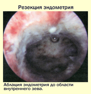 Методика резекции эндометрия, фото