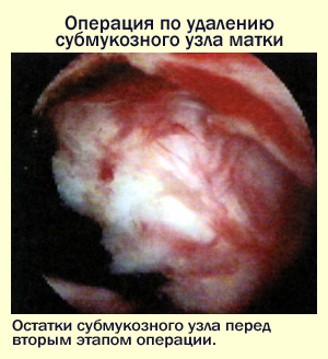 Операция по удалению субмукозных узлов матки, фото