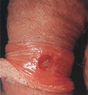Первичный сифилис, фото