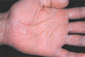 Шелушение кожи на ладонях, фото