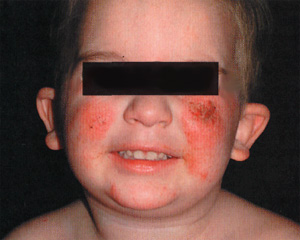 Атопический дерматит у детей, фото