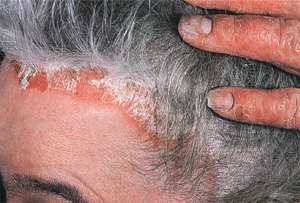 Псориаз волосистой части головы, фото