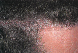 Лечение псориаза волосистой части головы, фото