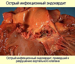 Эндокардит, фото