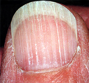 Продольные бороздки на ногтях, фото