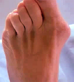 Деформация большого пальца стопы, фото