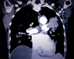 Современная диагностика рака легких, фото