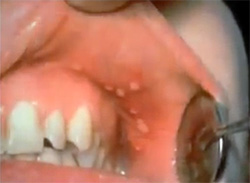 Пузырьки во рту при герпетическом стоматите, фото