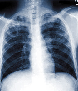 Рентгенограмма грудной клетки пациетна с туберкулезом, фото