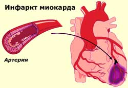 инфаркт миокарда, фото