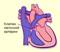 Стеноз клапанов легочной артерии, фото