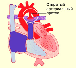 Открытый артериальный проток, фото
