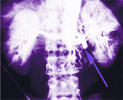 Тромбоз мезентериальных артерий, фото