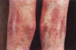 Проявления атопического дерматита, фото