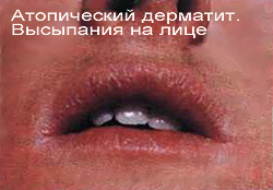 Атопический дерматит взрослых на лице, фото