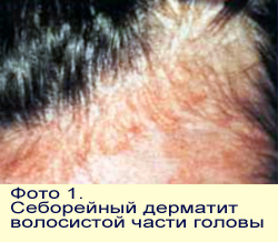 Как выглядит себорейный дерматит волосистой части головы, фото