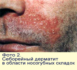 Как выглядит себорейный дерматит лица, фото