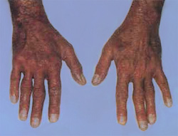 Аллергия на резину, как выглядит, фото